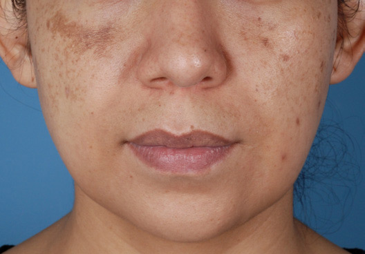 Patient 13 before photo of Melasma patient at Sensational Skin Scottsdale