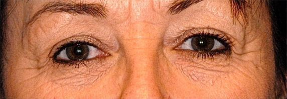 Patient 10 before photo of Laser EyeLid Lift patient at Sensational Skin Scottsdale