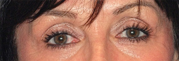 Patient 10 after photo of Laser EyeLid Lift patient at Sensational Skin Scottsdale