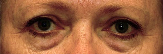 Patient 12 before photo of Laser EyeLid Lift patient at Sensational Skin Scottsdale