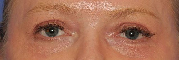 Patient 12 after photo of Laser EyeLid Lift patient at Sensational Skin Scottsdale