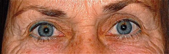 Patient 13 before photo of Laser EyeLid Lift patient at Sensational Skin Scottsdale