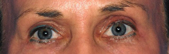 Patient 13 after photo of Laser EyeLid Lift patient at Sensational Skin Scottsdale