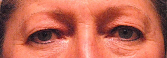 Patient 15 before photo of Laser EyeLid Lift patient at Sensational Skin Scottsdale