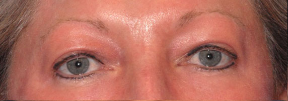 Patient 15 after photo of Laser EyeLid Lift patient at Sensational Skin Scottsdale