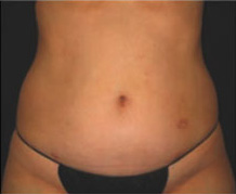 Patient 1 before photo of Cellulite Treatment patient at Sensational Skin Scottsdale