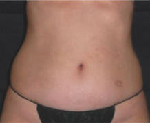 Patient 1 after photo of Cellulite Treatment patient at Sensational Skin Scottsdale