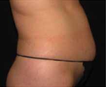 Patient 1 before photo of Cellulite Treatment patient at Sensational Skin Scottsdale