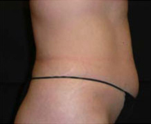 Patient 1 after photo of Cellulite Treatment patient at Sensational Skin Scottsdale