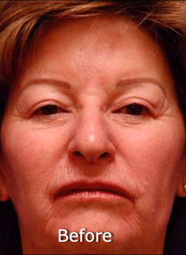 Patient 3 before photo of Active FX™ Laser Skin Tightening patient at Sensational Skin Scottsdale