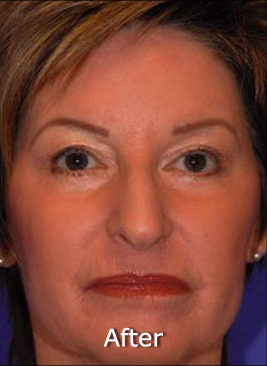 Patient 3 after photo of Active FX™ Laser Skin Tightening patient at Sensational Skin Scottsdale
