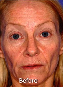 Patient 5 before photo of Active FX™ Laser Skin Tightening patient at Sensational Skin Scottsdale