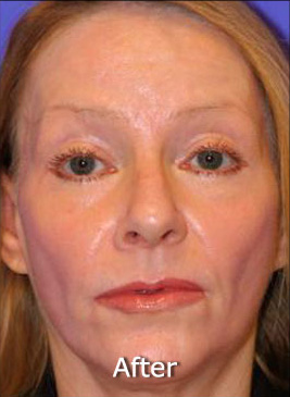 Patient 5 after photo of Active FX™ Laser Skin Tightening patient at Sensational Skin Scottsdale