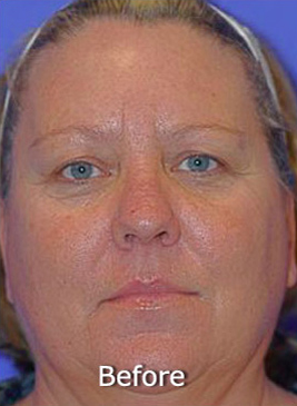 Patient 6 before photo of Active FX™ Laser Skin Tightening patient at Sensational Skin Scottsdale