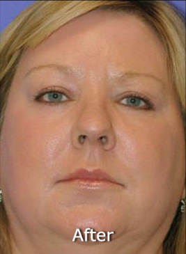Patient 6 after photo of Active FX™ Laser Skin Tightening patient at Sensational Skin Scottsdale