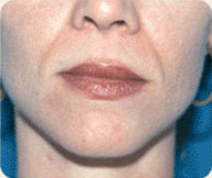 Before Sculptra patient