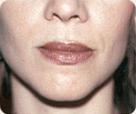 After Sculptra patient