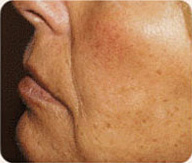 Before Sculptra patient