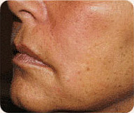 After Sculptra patient