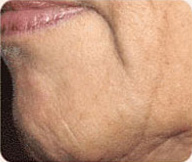 Before Sculptra patient