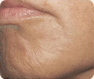 After Sculptra patient