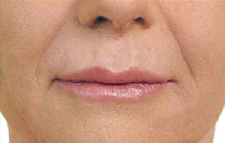 Patient 3 after photo of Juvederm patient at Sensational Skin Scottsdale
