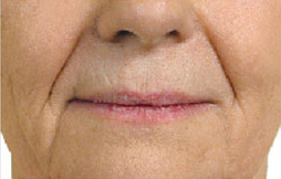 Patient 3 before photo of Juvederm patient at Sensational Skin Scottsdale