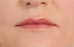 Patient 5 after photo of Juvederm patient at Sensational Skin Scottsdale