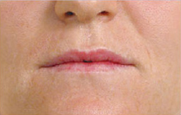 Patient 5 before photo of Juvederm patient at Sensational Skin Scottsdale