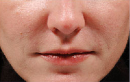 Patient 6 after photo of Juvederm patient at Sensational Skin Scottsdale