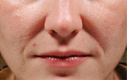 Patient 6 before photo of Juvederm patient at Sensational Skin Scottsdale