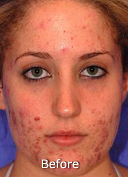 Patient 4 before photo of Acne & Acne Scar Laser Treatment patient at Sensational Skin Scottsdale