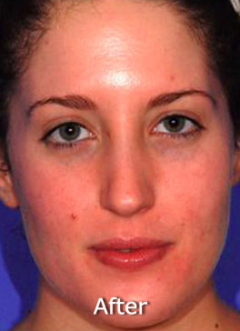 Patient 4 after photo of Acne & Acne Scar Laser Treatment patient at Sensational Skin Scottsdale
