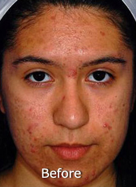 Patient 7 before photo of Acne & Acne Scar Laser Treatment patient at Sensational Skin Scottsdale