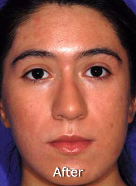 Patient 7 after photo of Acne & Acne Scar Laser Treatment patient at Sensational Skin Scottsdale