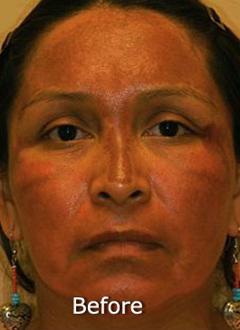 Patient 4 before photo of Obagi™ Systems patient at Sensational Skin Scottsdale