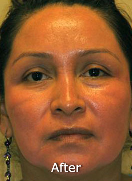 Patient 4 after photo of Obagi™ Systems patient at Sensational Skin Scottsdale