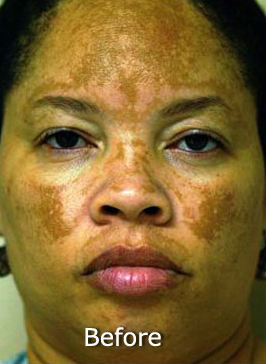 Patient 5 before photo of Obagi™ Systems patient at Sensational Skin Scottsdale