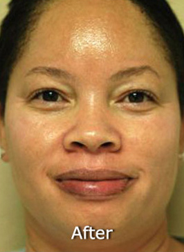 Patient 5 after photo of Obagi™ Systems patient at Sensational Skin Scottsdale