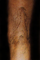 Before Vein Removal patient