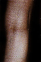 After Vein Removal patient