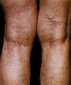 Before Vein Removal patient