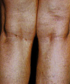 After Vein Removal patient