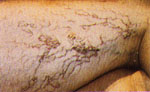 Before Vein Removal patient