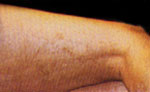 After Vein Removal patient