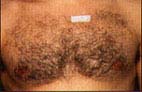 Before Hair Removal patient
