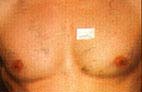 After Hair Removal patient