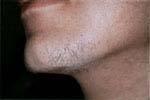 Before Hair Removal patient
