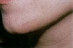 After Hair Removal patient