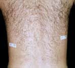 Before Hair Removal patient